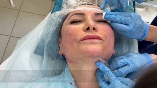 Устранение носогубных морщин Часть 1 смотреть онлайн