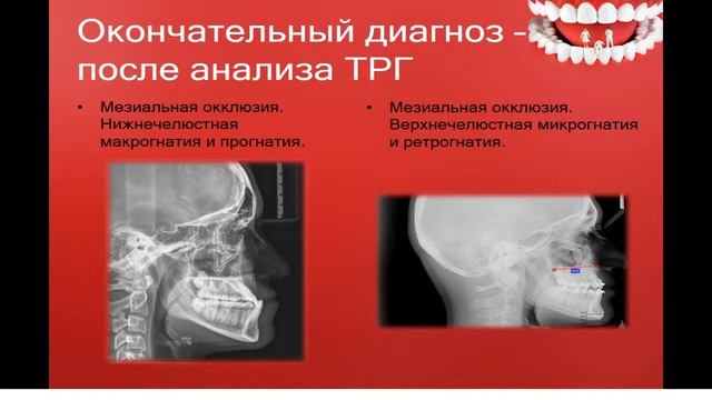 13:50  Аномалии окклюзии