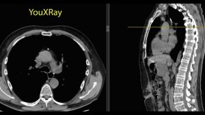 Лучевая анатомия средостения