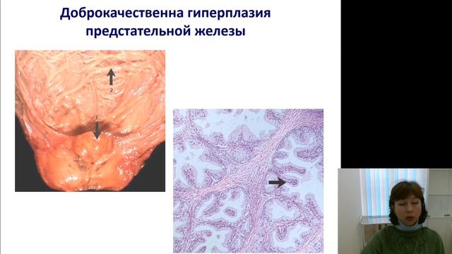 Патанатомия 4.Процессы компенсации и адаптации