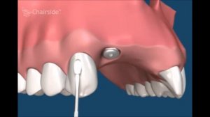 Как происходит протезирование имплантами  Ортопедическая стоматология