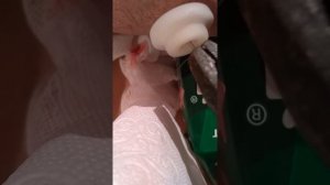 Как я вытаскивал спицы из руки)