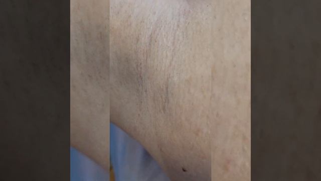 Лазерная эпиляция в "Ассоль". Диодный лазер, 6 процедур. смотреть онлайн