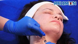 «MELSMON – НИТИ» Коррекция нижней трети лица