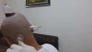 Хиджама, пример процедуры