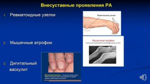 4 курс СФ. Лекция на тему: "Ревматоидный артрит".