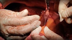 Анастомозы - глушим кишку полукисетами