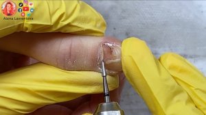 Прищемила палец дверью / Сошел ноготь на руке, что делать?