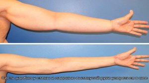 Лимфодренаж руки: когда и как делать