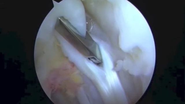 Loop Biceps Tenotomy: An Arthroscopic Technique For Long Head Of Biceps Tenotomy