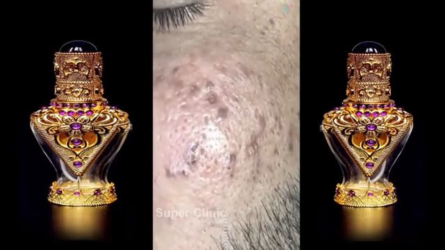 лечение прыщей   Удаление черных точек