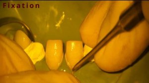 Фиксация виниров Veneers fixation