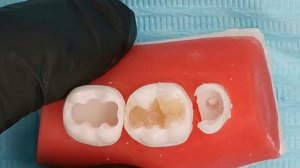 Class II Composite build up in Lower First Molar (Centripetal and Cusp by Cusp build up techniques)