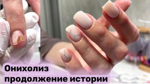 ОНИХОЛИЗИС НА НОГТЯХ / ГЕЛЬ-ЛАК: ПОЛЬЗА ИЛИ ВРЕД?