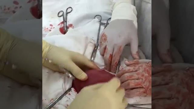 Удаление матки с гигантской миомой смотреть онлайн