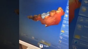 Сломался зуб? Вам на быстрое восстановление зуба коронкой в "32 Практика"