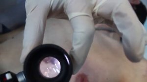 Лазерное удаление новообразований кожи в Клинике Лазерная медицина Калининград