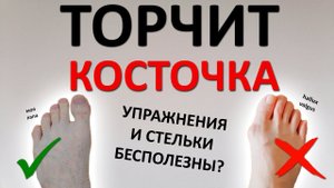 Торчит КОСТОЧКА на ноге (hallux valgus). Упражнения и стельки вас НЕ СПАСУТ. Как избежать операции?