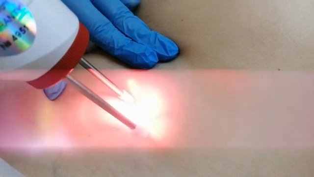 Удаление гемангиом неодимовым лазером в АРклиник смотреть онлайн