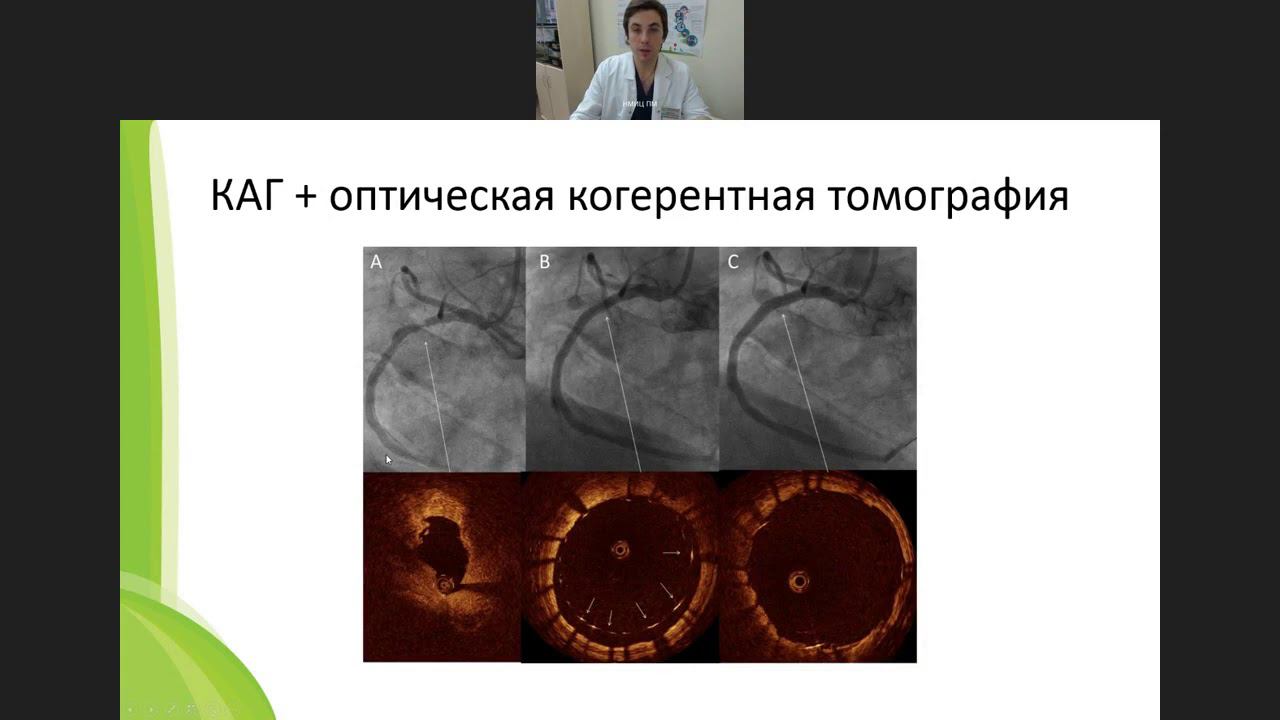 Показания к проведению коронарной ангиографии. Какой метод реваскуляризации миокарда выбрать?