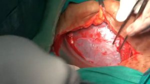 cesarean birth / C Section / LSCS/ Child Birth