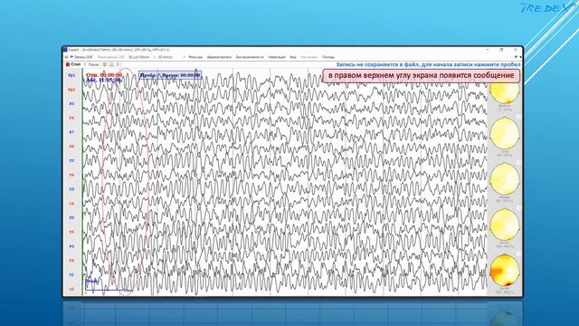 «ЭкспертТМ-Compact». Часть1. Регистрация ЭЭГ. смотреть онлайн