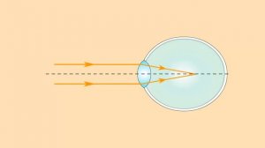 Коррекция близорукости