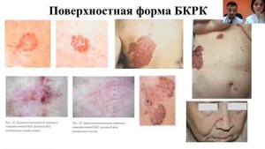 БАЗАЛЬНО-КЛЕТОЧНЫЙ РАК