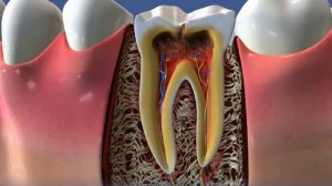 Осложнения кариеса