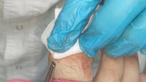 Лечение вросшего ногтя (ОНИХОКРИПТОЗА)