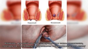 Как правильно лежать, не травмируя геморрой