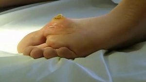 02.Удаление подошвенных бородавок сургитроном FLAT WARTS.№2