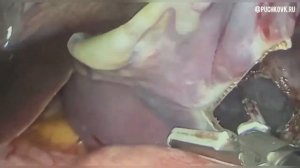 Лапароскопическое иссечение кисты селезенки