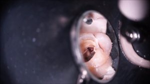 Очистка  каналов и обтурация   с МТА небного канала.