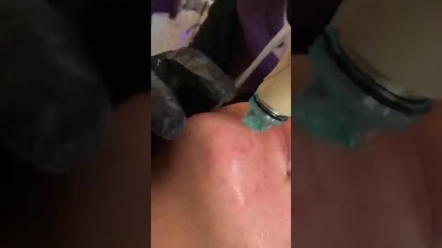 HydraFacial Extractions смотреть онлайн