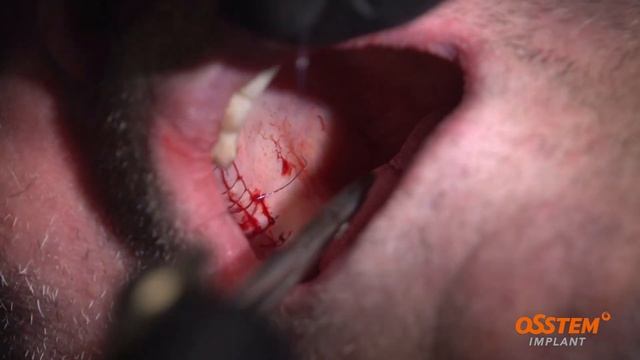 Master Course Osstem. Basic Surgery. Операція № 1 смотреть онлайн