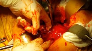 Карбункулы почки. Нефрэктомия слева