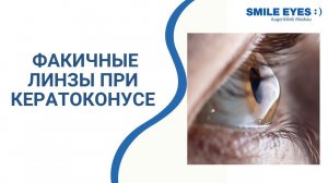 Факичные линзы при кератоконусе