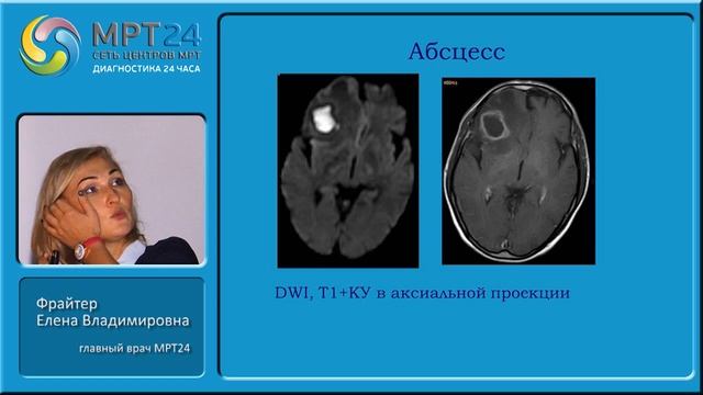 Фрайтер Е.В. "МРТ в диагностике энцефалитов " смотреть онлайн