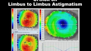 Webinar | Orthokeratology topography and the Euclid Emerald lens