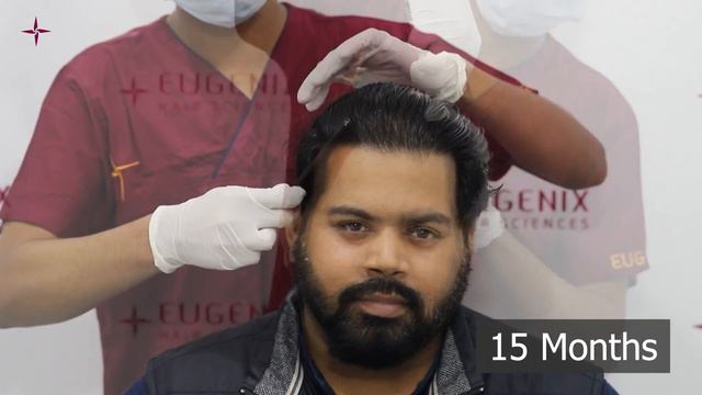 Patient Testimonial - Norwood Grade 5 baldness, 4596 grafts and a 15-month update at Eugenix. смотреть онлайн