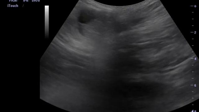 Ущемленная грыжа передней брюшной стенки. смотреть онлайн