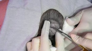 "Oh My God!": A Massive Pilar Cyst Explodes On Dr Lee | Dr. Pimple Popper
