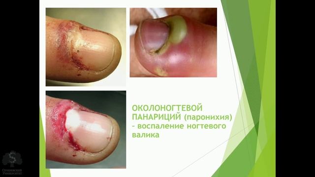 Гнойные заболевания пальцев и кисти