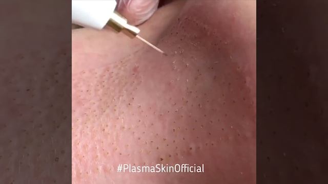 Подтяжка шеи холодной плазмой. PlasmaSkin™️
