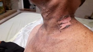 8 июня 2022 г. Последствия лучевой терапии. Жуткие ожоги. #рак #уменярак #онкология