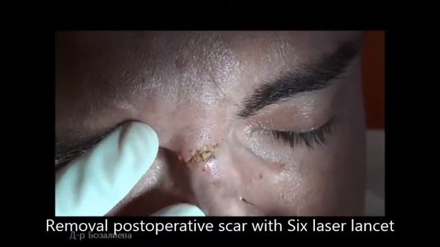 Removal of postoperative scar with Six laser lancet смотреть онлайн