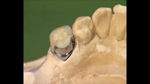 Что такое бюгельный протез. Что делать если нет многих зубов на челюсти