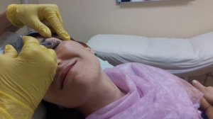 Заполнение морщин филлером Surgiderm 30XP (Франция)