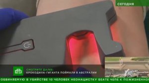 Комментарий флеболога для ТВ